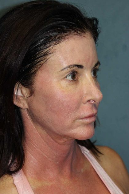 Facelift Before & After Patient #567