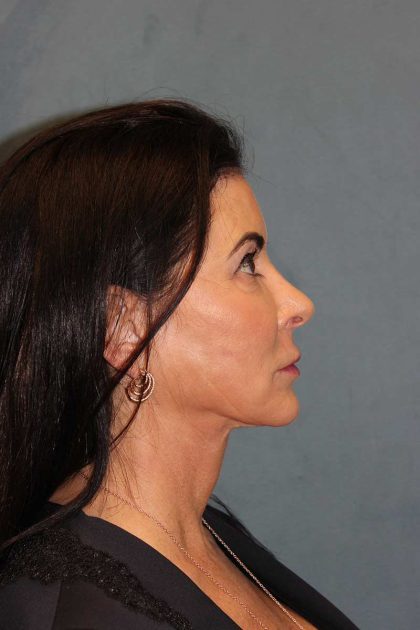 Facelift Before & After Patient #567