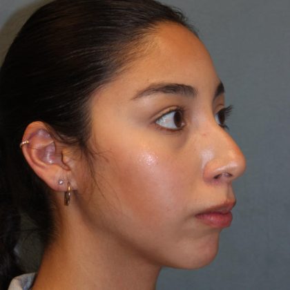 Rhinoplasty Before & After Patient #1586