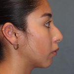 Rhinoplasty Before & After Patient #1586