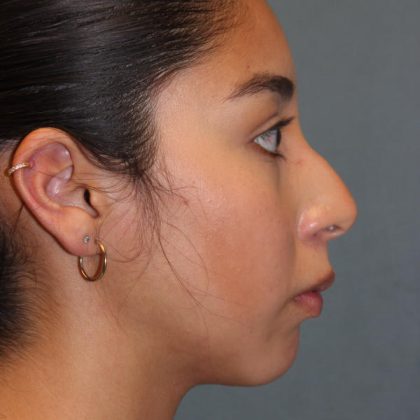 Rhinoplasty Before & After Patient #1586