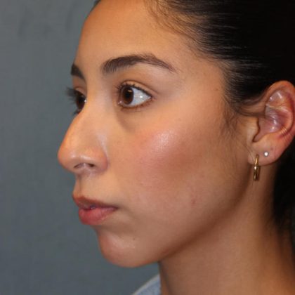 Rhinoplasty Before & After Patient #1586