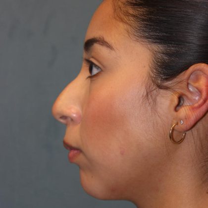 Rhinoplasty Before & After Patient #1586