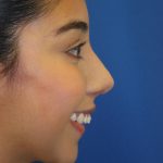 Rhinoplasty Before & After Patient #1586