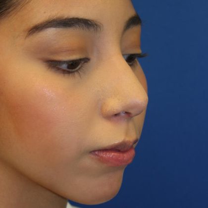 Rhinoplasty Before & After Patient #1586