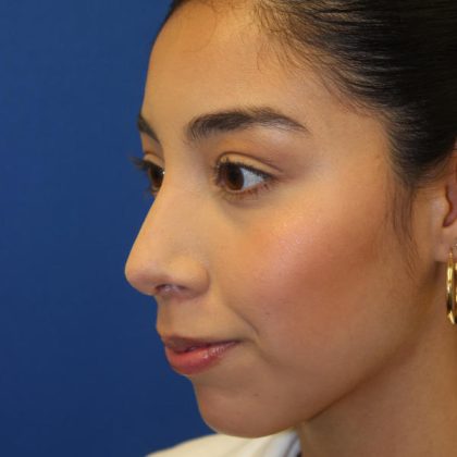 Rhinoplasty Before & After Patient #1586