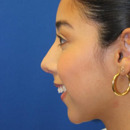 Rhinoplasty Before & After Patient #1586