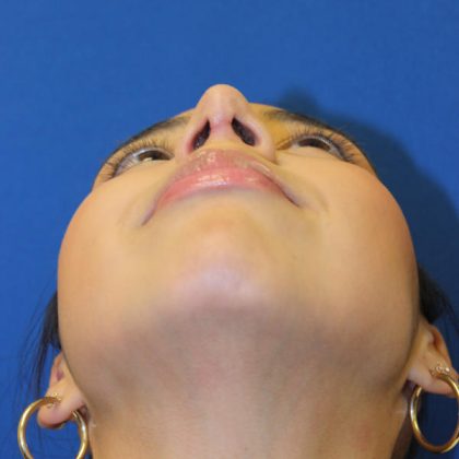 Rhinoplasty Before & After Patient #1586