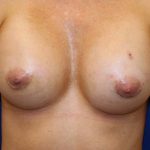 Breast Augmentation Before & After Patient #3581