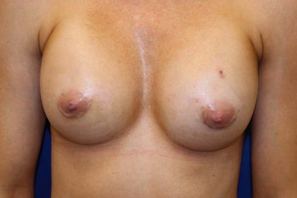 Breast Augmentation Before & After Patient #3581