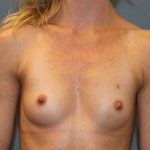 Breast Augmentation Before & After Patient #3581