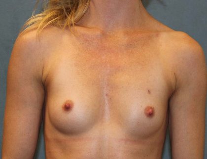 Breast Augmentation Before & After Patient #3581