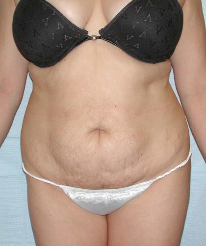 Liposuction Before & After Patient #2780