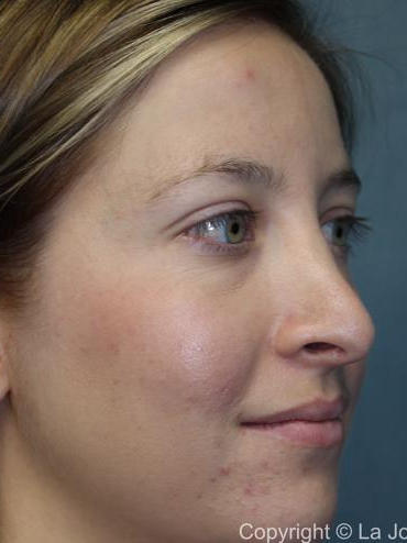 Rhinoplasty Before & After Patient #1742