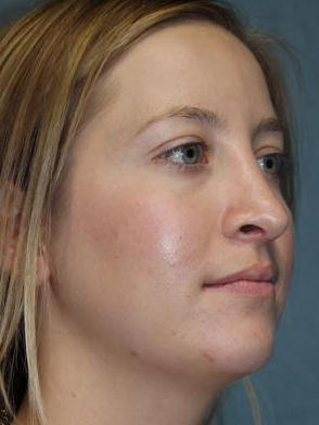 Rhinoplasty Before & After Patient #1742