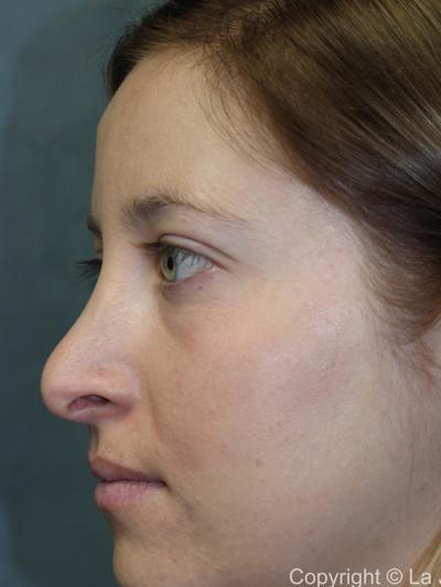 Rhinoplasty Before & After Patient #1742