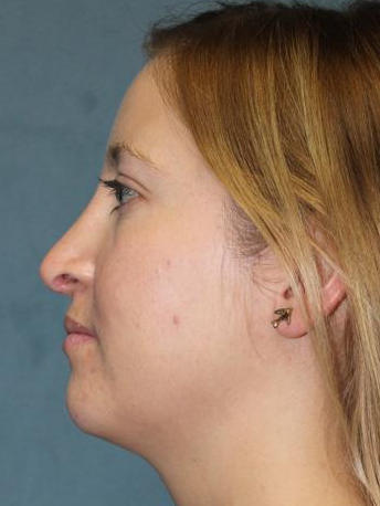 Rhinoplasty Before & After Patient #1742