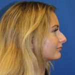 Rhinoplasty Before & After Patient #1608