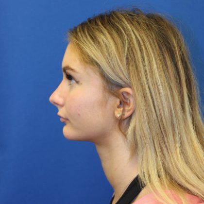 Rhinoplasty Before & After Patient #1608