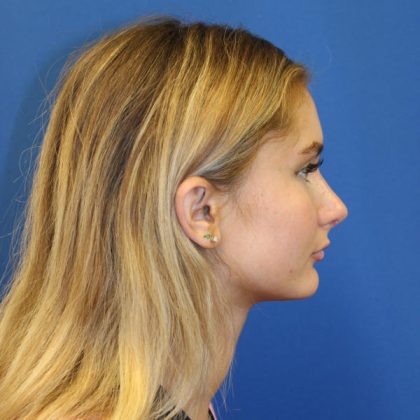 Rhinoplasty Before & After Patient #1608