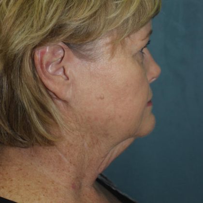 Facelift Before & After Patient #1780