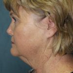 Facelift Before & After Patient #1780