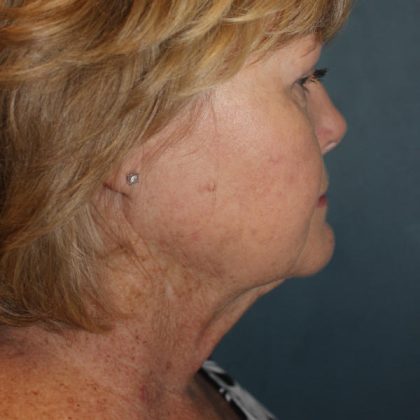 Facelift Before & After Patient #1780