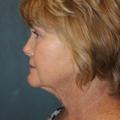 Facelift Before & After Patient #1780