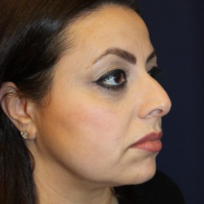 Rhinoplasty Before & After Patient #1719