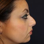 Rhinoplasty Before & After Patient #1719