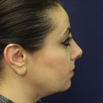 Rhinoplasty Before & After Patient #1719