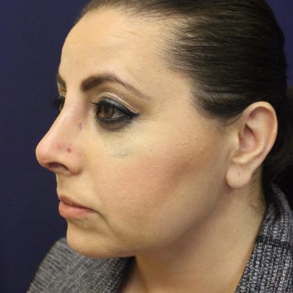 Rhinoplasty Before & After Patient #1719