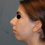 Rhinoplasty Before & After Patient #1732