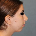 Rhinoplasty Before & After Patient #1732