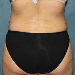 Tummy Tuck Before & After Patient #1832