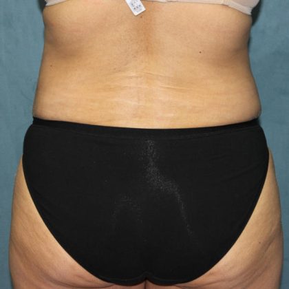 Tummy Tuck Before & After Patient #1832