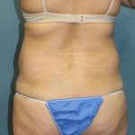 Tummy Tuck Before & After Patient #1832