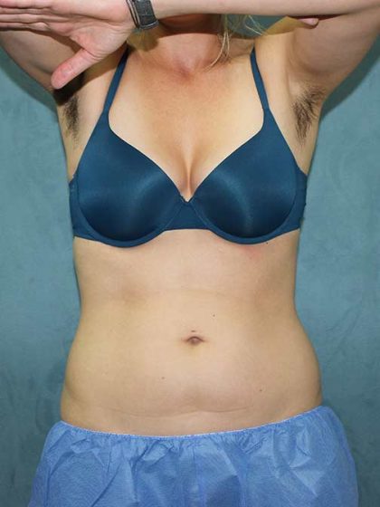 Coolsculpting Before & After Patient #1332