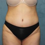 Tummy Tuck Before & After Patient #1832