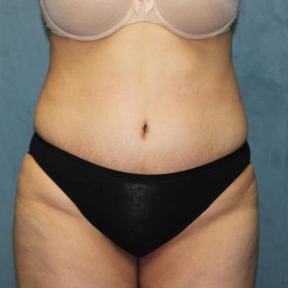 Tummy Tuck Before & After Patient #1832