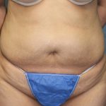 Tummy Tuck Before & After Patient #1832