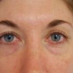 Blepharoplasty Before & After Patient #2775