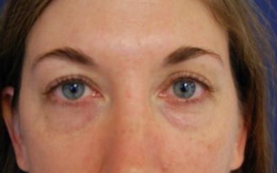 Blepharoplasty Before & After Patient #2775