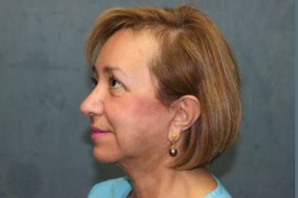Facelift Before & After Patient #2986