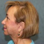 Facelift Before & After Patient #2986