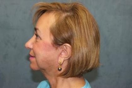 Facelift Before & After Patient #2986