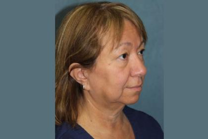 Facelift Before & After Patient #2986