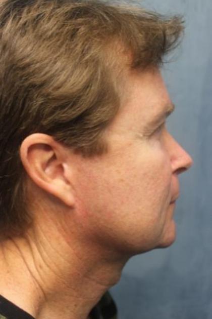 Facelift Before & After Patient #3073