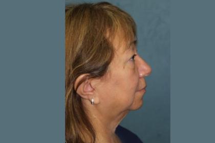 Facelift Before & After Patient #2986