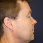 Facelift Before & After Patient #3073